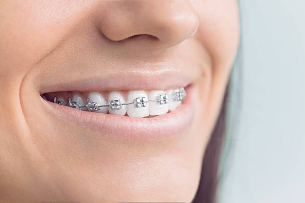 Dental Bonding in Ramona, CA